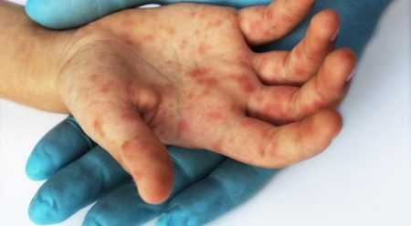 Alarm i OBSH-së, në Shqipëri fruthi përhapet lehtësisht! Faktorët...[VIDEO]